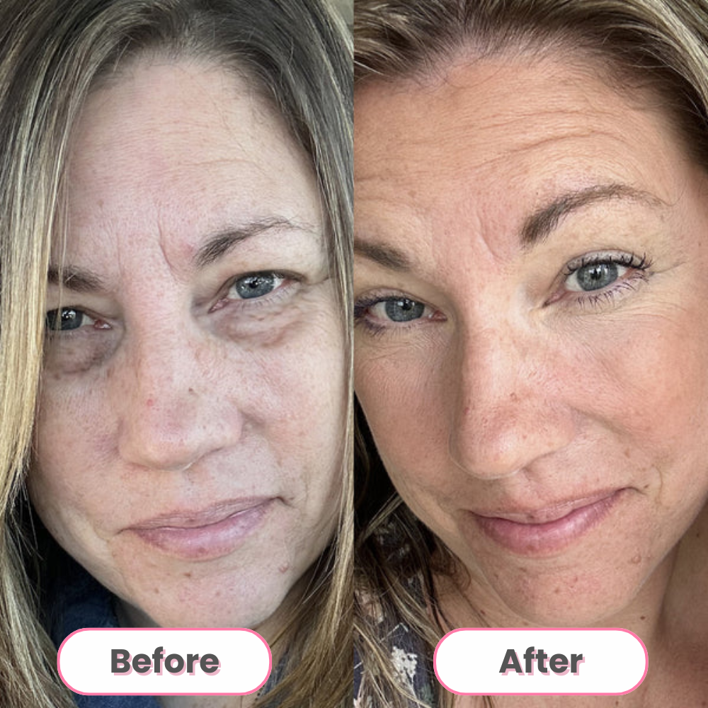 GlowWave™ Under-Eye Therapy