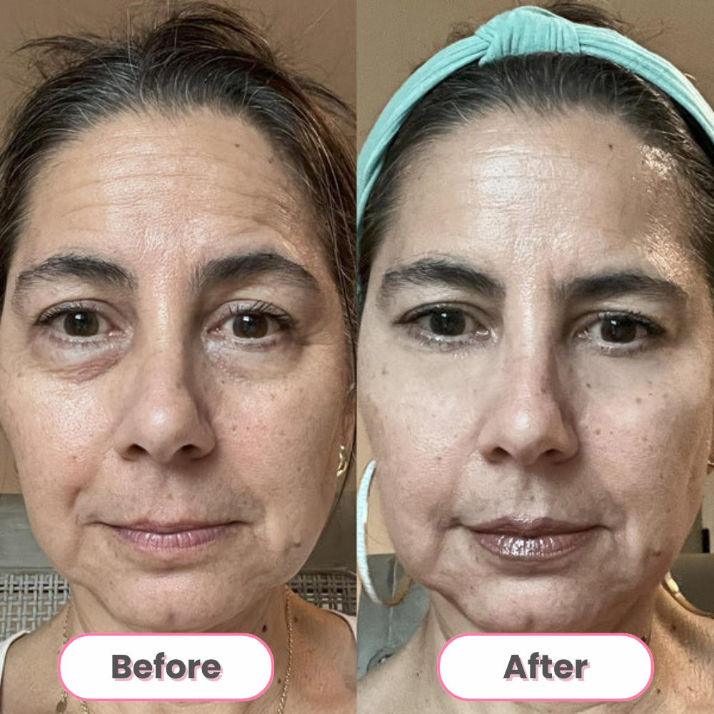 GlowWave™ Under-Eye Therapy